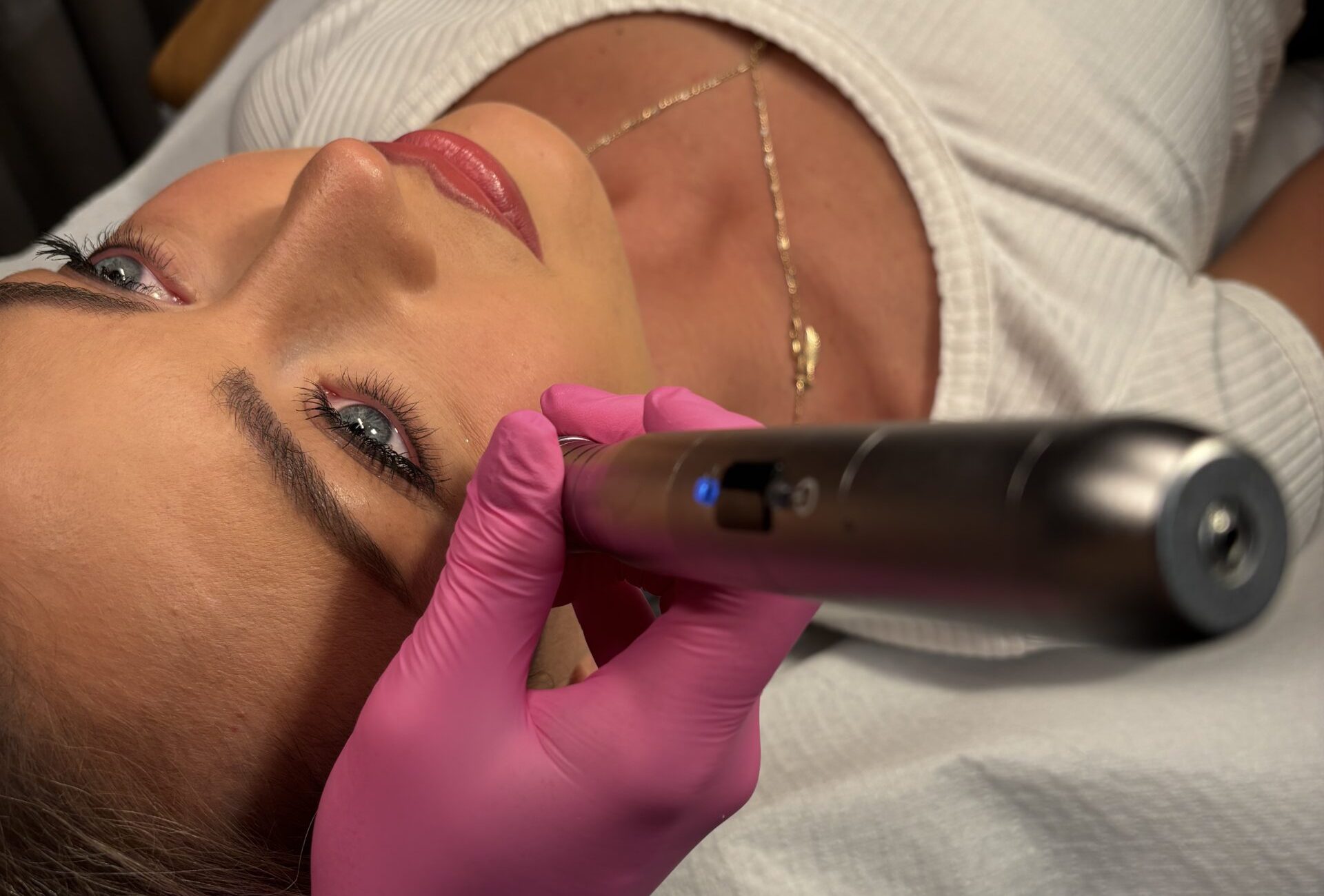 Mezoterapia mikroigłowa